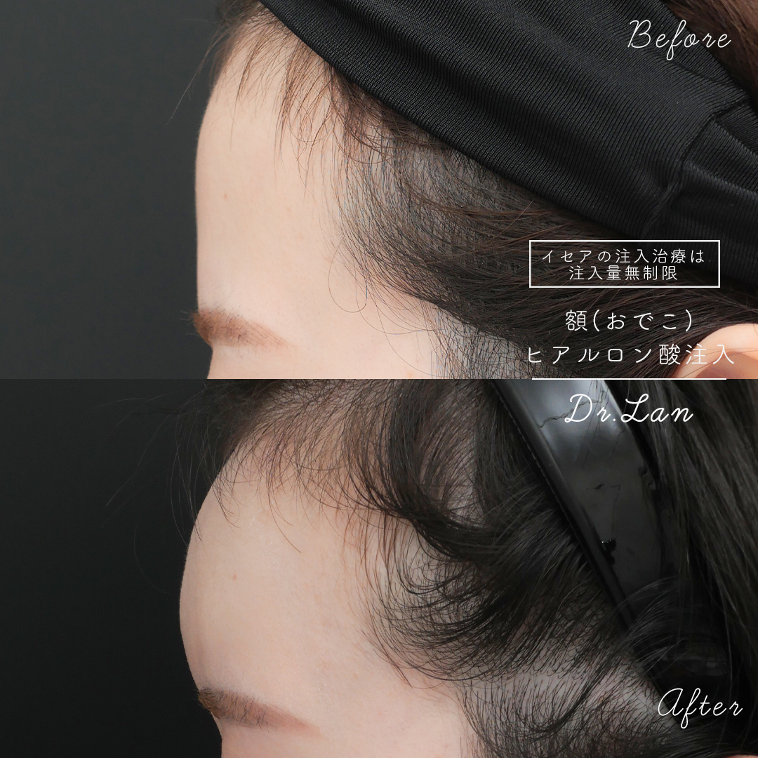 おでこがヒアルロン酸注入でボコボコに 原因と対処法を医師が解説 ドクターブログ ヒアルロン酸 ボトックス注射 東京 新宿 なら東京イセアクリニック