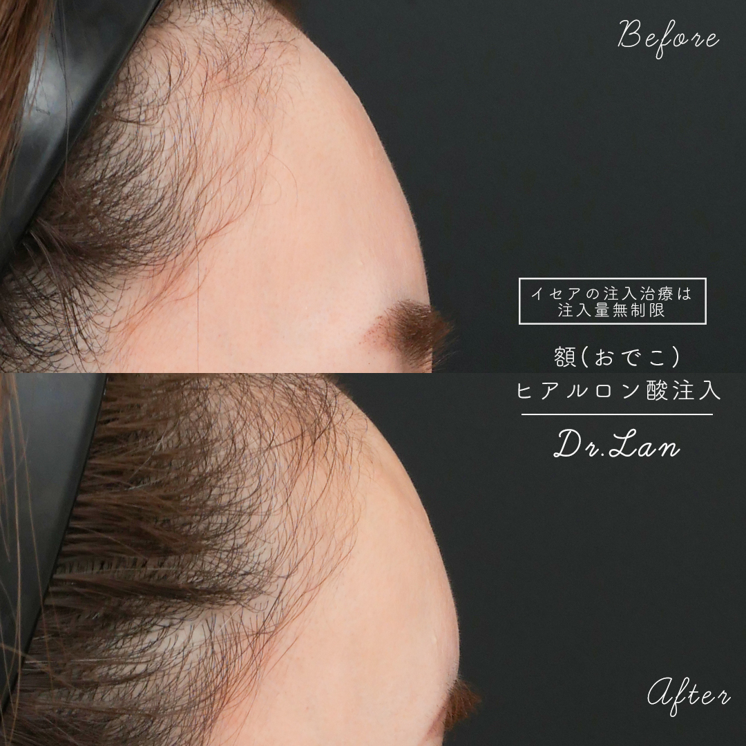 おでこがヒアルロン酸注入でボコボコに 原因と対処法を医師が解説 ドクターブログ ヒアルロン酸 ボトックス注射 東京 新宿 なら東京イセアクリニック