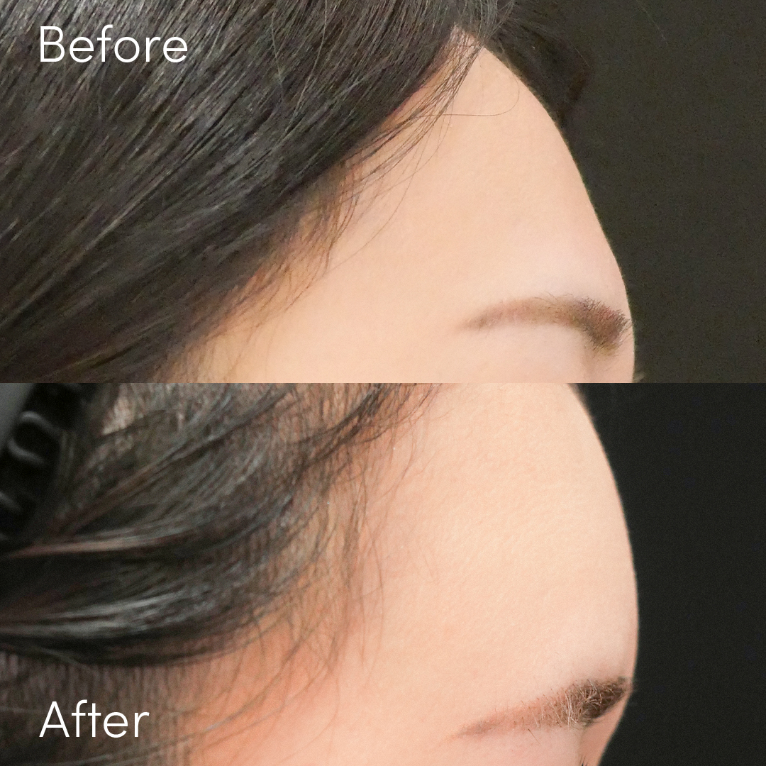 額のヒアルロン酸注入で頭痛 原因と対処法を医師が解説 ドクターブログ ヒアルロン酸 ボトックス注射 東京 新宿 なら東京イセアクリニック