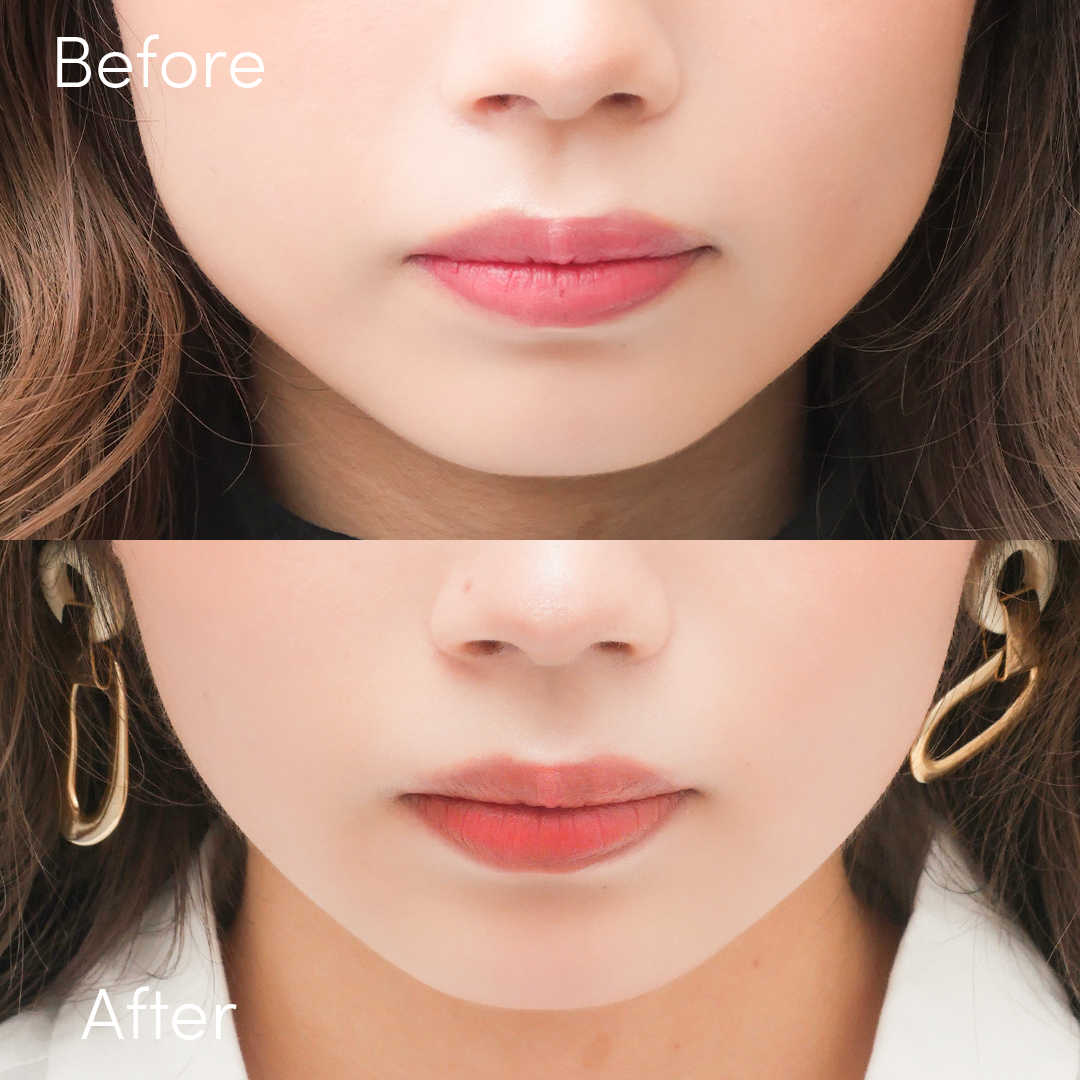 エラボトックスは保険適用できる 料金を抑えるコツもご紹介 ドクターブログ ヒアルロン酸 ボトックス注射 東京 新宿 なら東京イセアクリニック