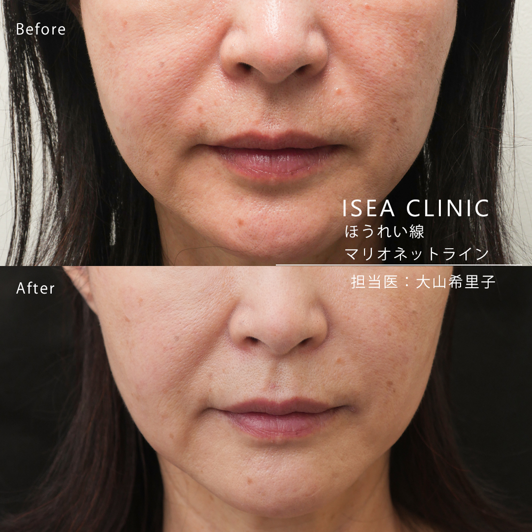 頬のヒアルロン酸注入について特徴や料金を医師が解説 ドクターブログ ヒアルロン酸 ボトックス注射 東京 新宿 なら東京イセアクリニック