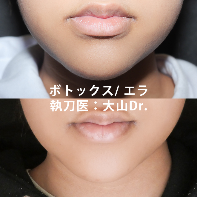 ボトックス エラ 大山医師の症例写真no 0 ヒアルロン酸 ボトックス注射なら東京イセアクリニック