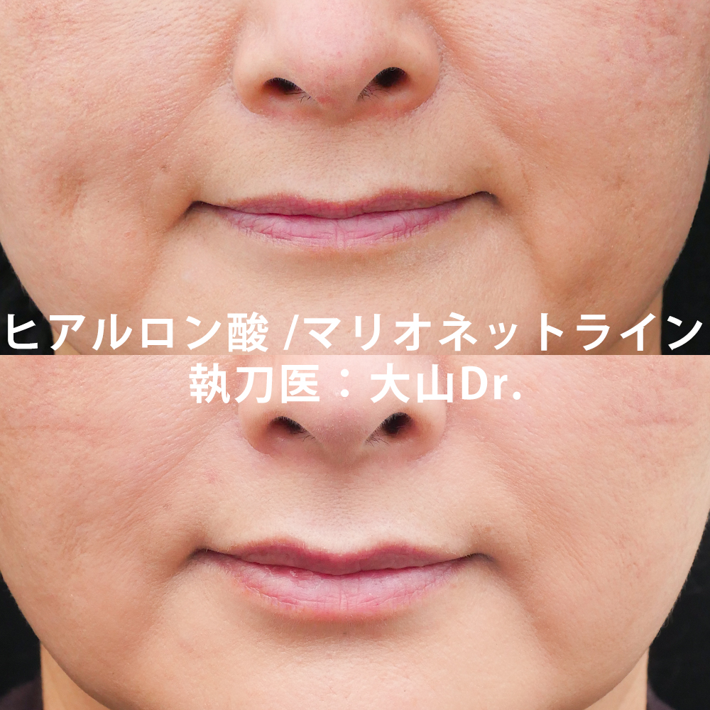 ヒアルロン酸注入 マリオネットライン 大山医師の症例写真no 031 ヒアルロン酸 ボトックス注射なら東京イセアクリニック