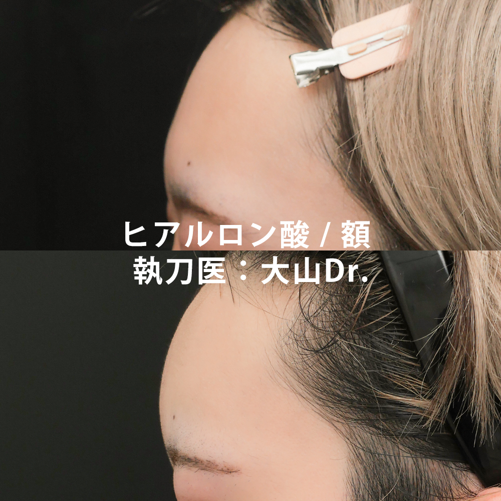 ヒアルロン酸注入の症例写真 ヒアルロン酸 ボトックス注射なら東京イセアクリニック