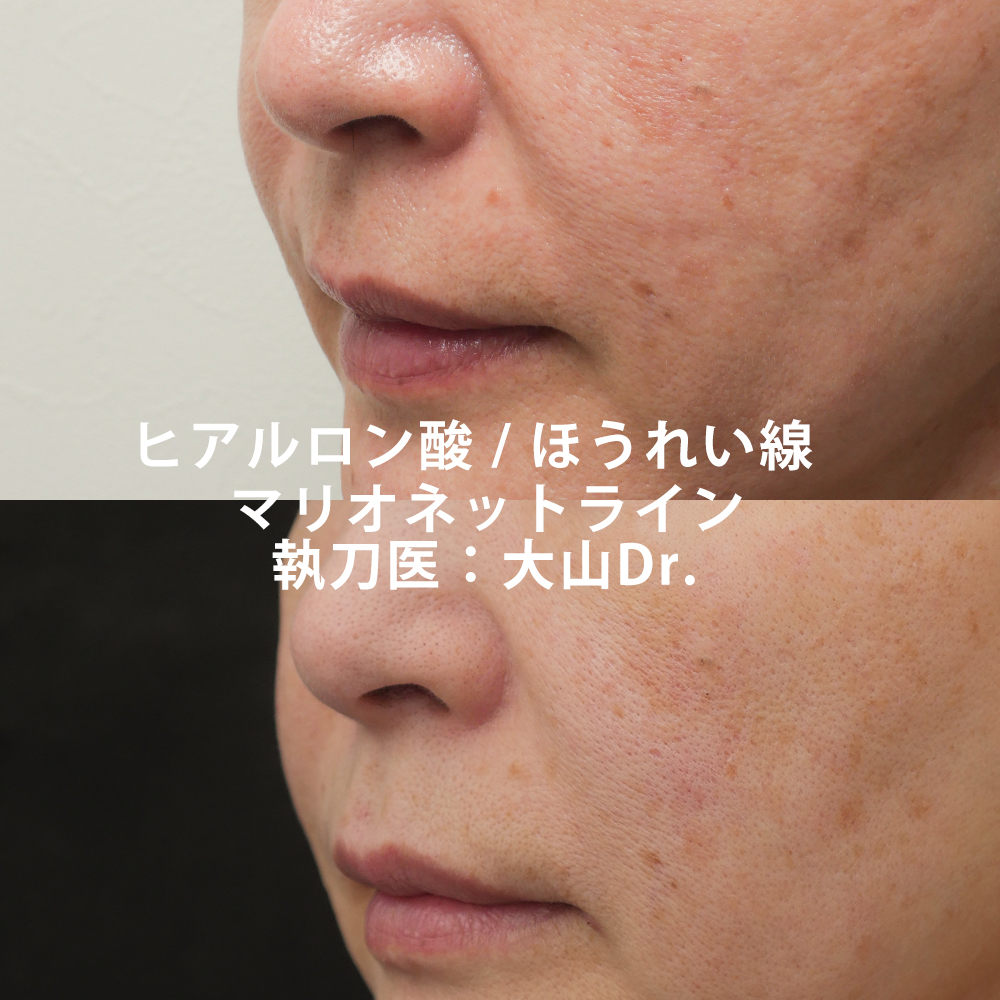 医師が解説 ヒアルロン酸注入による唇の腫れの経過は ドクターブログ ヒアルロン酸 ボトックス注射 東京 新宿 なら東京イセアクリニック