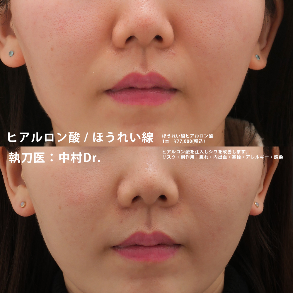 ほうれい線のヒアルロン酸注入、必要量はどれくらい?症例別に紹介