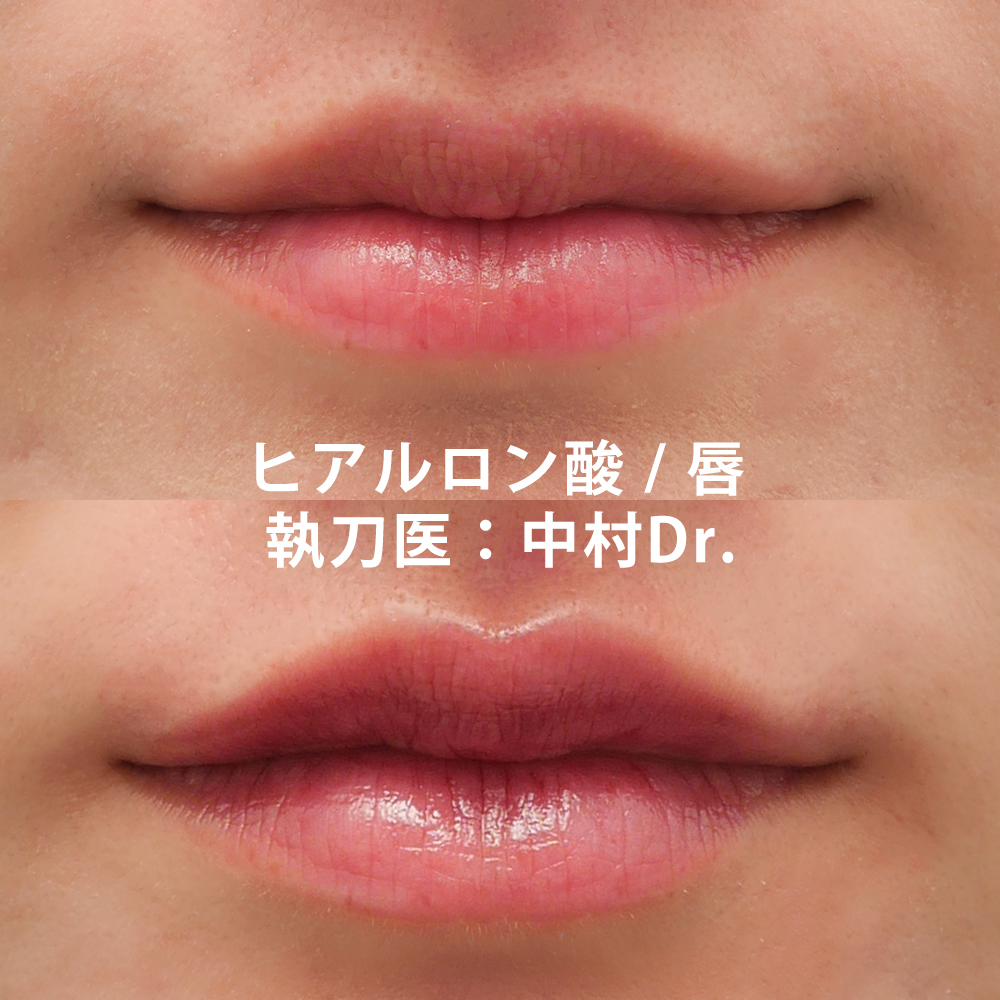 唇のヒアルロン酸のその他の症例