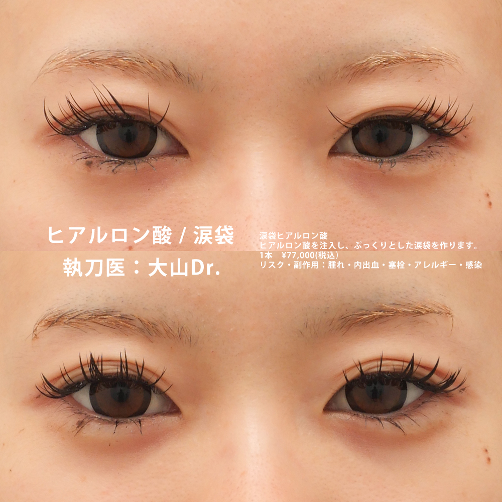 涙袋のヒアルロン酸のその他の症例