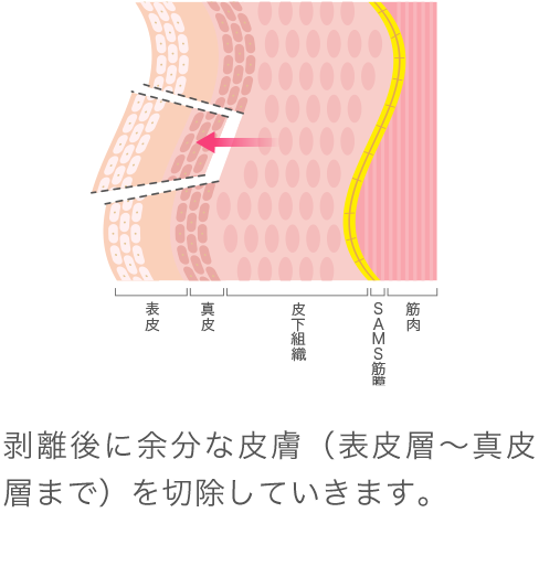 フェイスリフトなら形成外科医が施術する美容外科で リフトアップ たるみ治療 なら東京イセアクリニック 銀座 渋谷