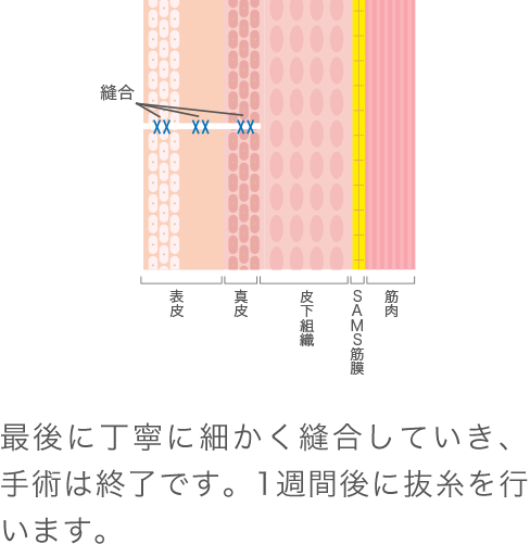 フェイスリフトなら形成外科医が施術する美容外科で リフトアップ たるみ治療 なら東京イセアクリニック