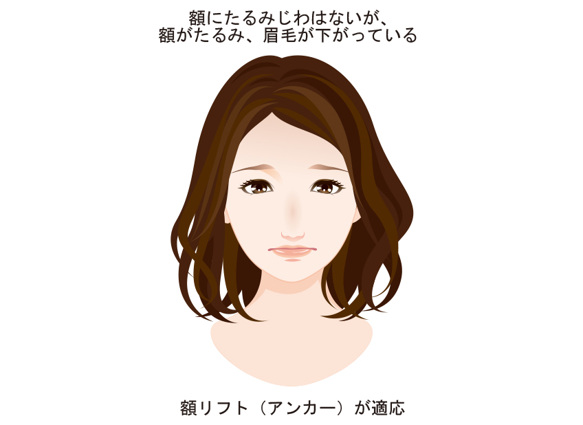 額リフト(アンカー)