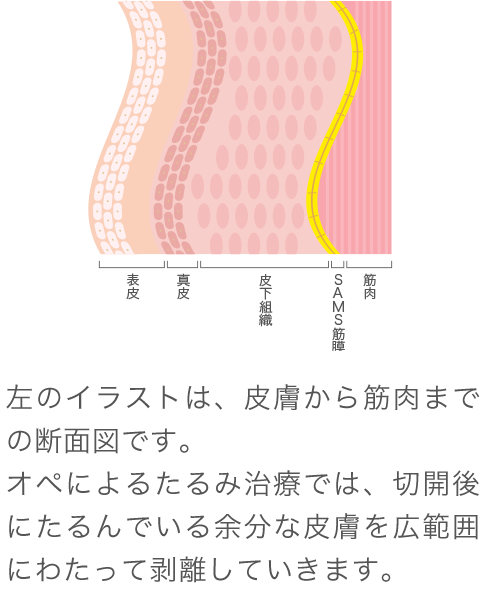 フェイスライン 口元のたるみを引き上げるミニリフト リフトアップ たるみ治療 なら東京イセアクリニック