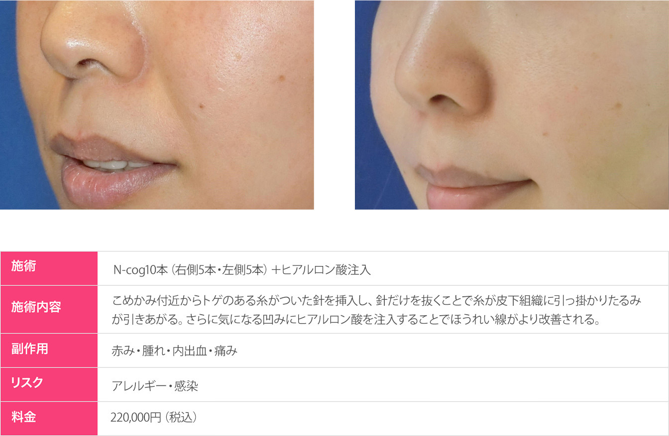 ほうれい線改善プラン症例