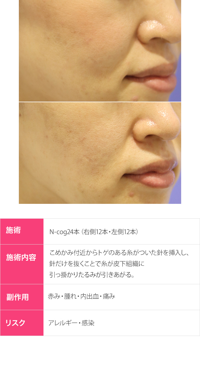 ほうれい線による糸治療特別プラン リフトアップ たるみ治療 なら東京イセアクリニック 銀座 渋谷 ほうれい線による糸治療特別プラン リフトアップ たるみ治療 なら東京イセアクリニック 銀座 渋谷