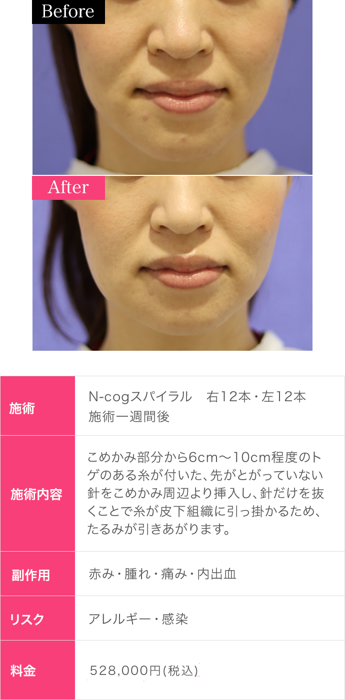 イセアがN-cog（エヌコグ）スパイラルを選ぶ理由｜リフトアップ