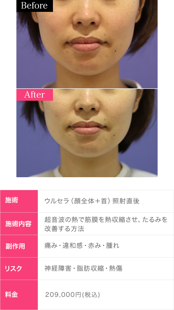 値下げ！ウルセラハイフ ウルセラシステム ： 肌（美容皮膚科）：美容 