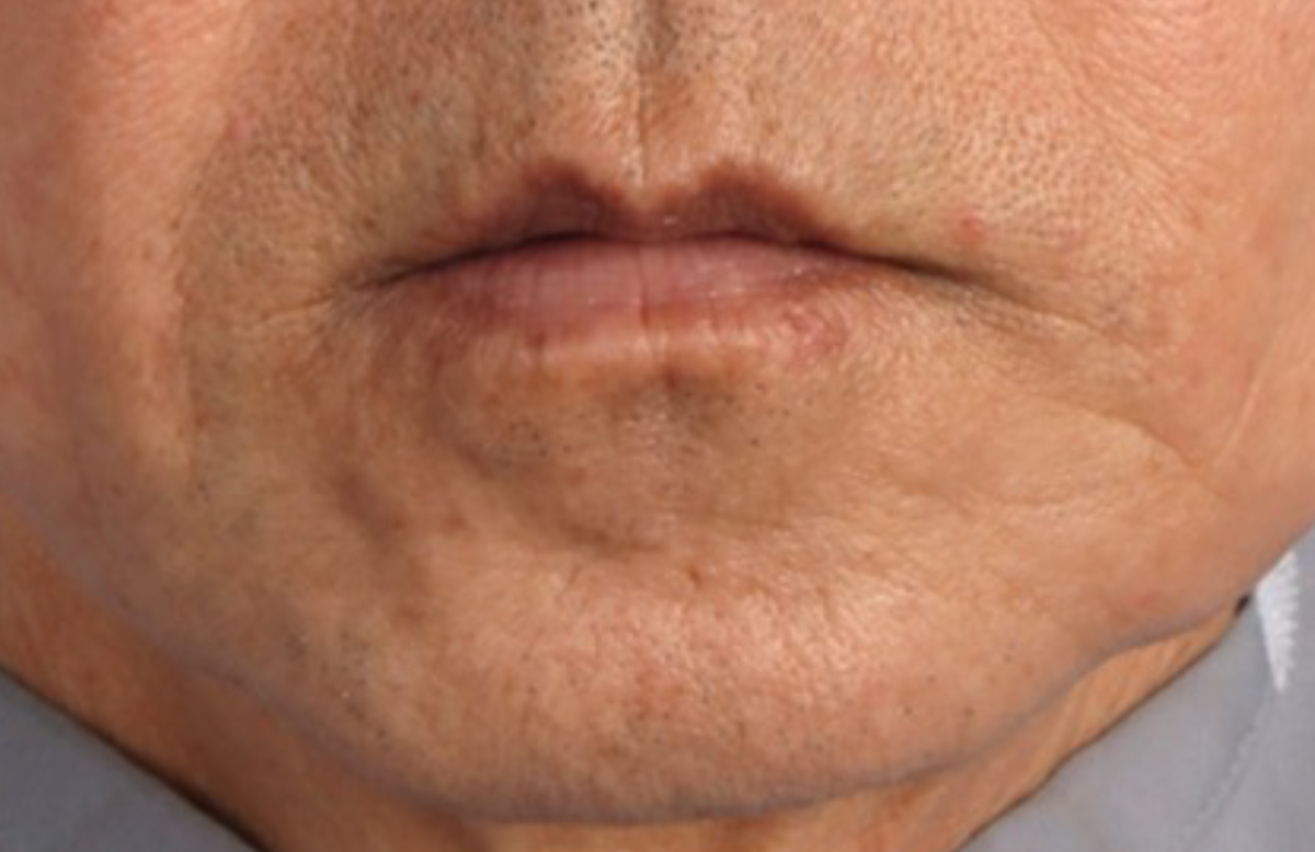 1回治療3か月後