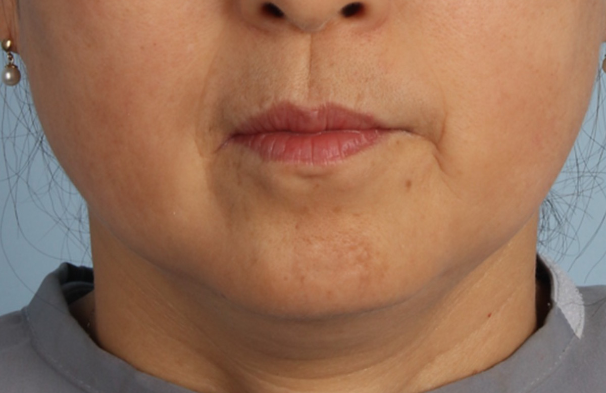 1回治療1か月後