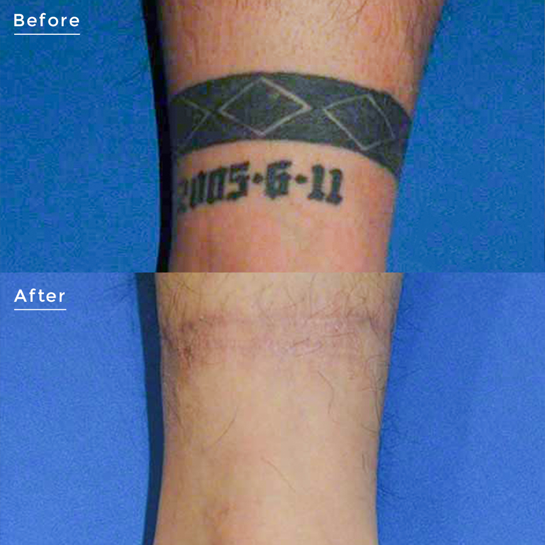 タトゥー除去 症例写真