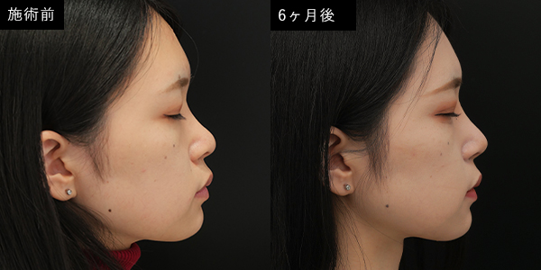 鼻尖形成後のメイクはいつからできる ドクターブログ 鼻の整形なら東京イセアクリニック