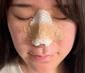 鼻プロテーゼのギプスは必須 装着期間も解説 ドクターブログ 鼻の整形なら東京イセアクリニック