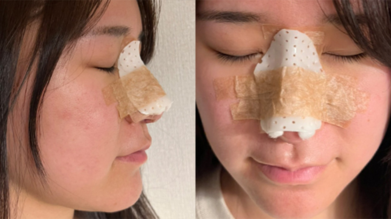 鼻プロテーゼのギプスは必須 装着期間も解説 ドクターブログ 鼻の整形なら東京イセアクリニック