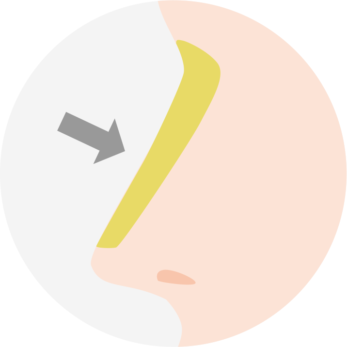 プロテーゼ隆鼻術