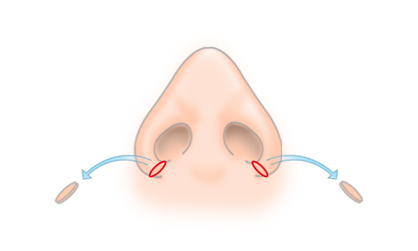 鼻翼縮小の手術方法 STEP2