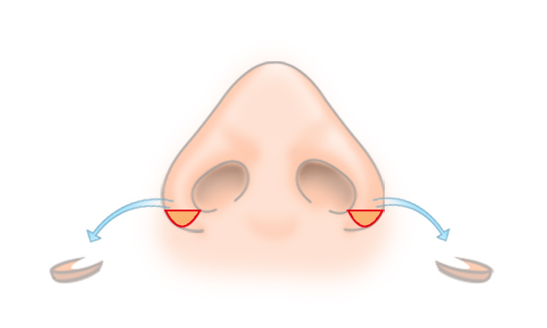鼻翼縮小の手術方法 STEP4