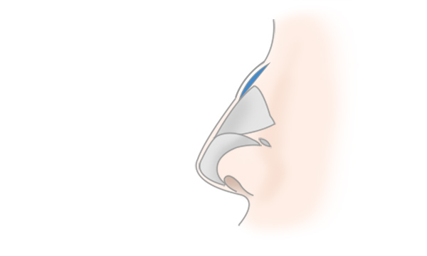 わし鼻修正・鼻骨削りの手術方法 STEP4