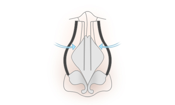 わし鼻修正・鼻骨削りの手術方法 STEP5