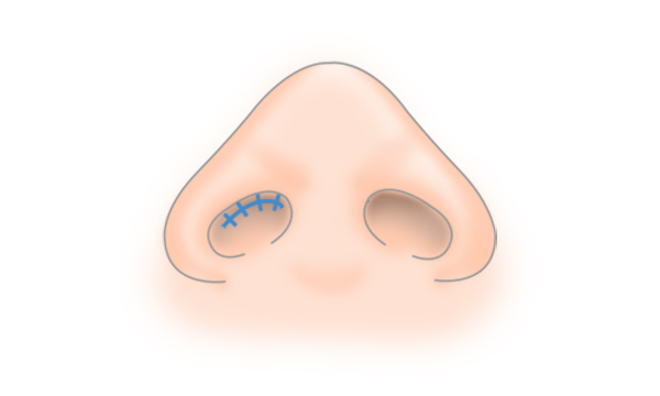 わし鼻修正・鼻骨削りの手術方法 STEP6