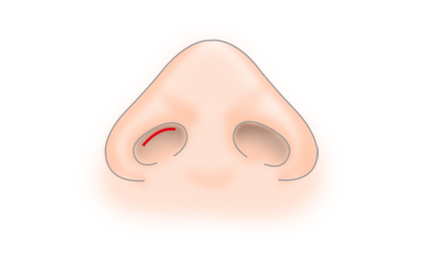 鼻骨幅寄せの手術方法 STEP2