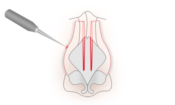 鼻骨幅寄せの手術方法 STEP4