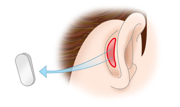 自家軟骨による隆鼻術の手術方法 STEP1