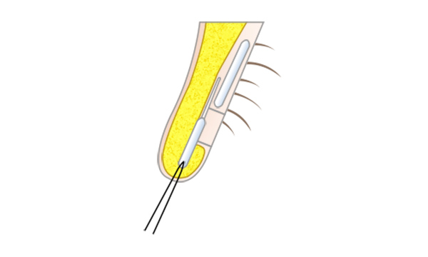 鼻孔縁形成の手術方法 STEP4