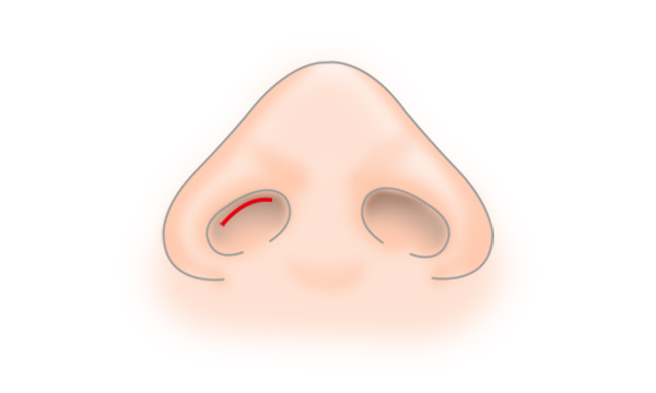 プロテーゼ隆鼻術の手術方法 STEP2