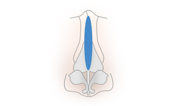 プロテーゼ隆鼻術の手術方法 STEP4