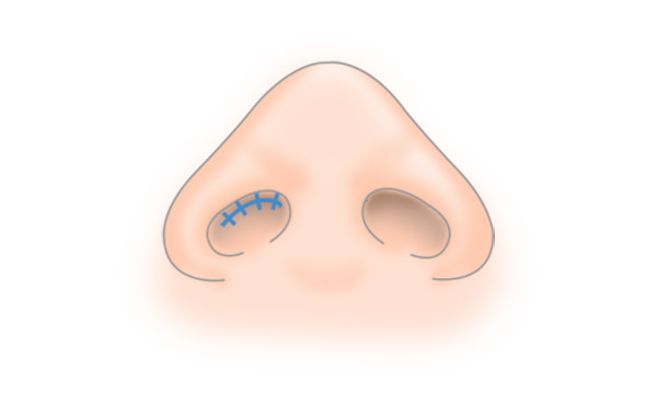プロテーゼ隆鼻術の手術方法 STEP5