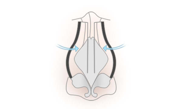 斜鼻修正の手術方法 STEP5
