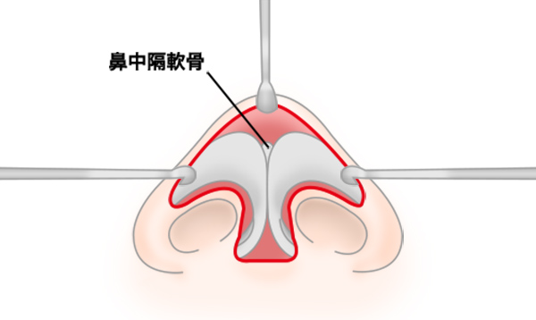 斜鼻修正の手術方法 STEP7