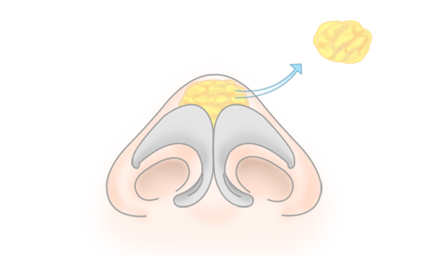 鼻尖形成・鼻尖縮小の手術方法 STEP4