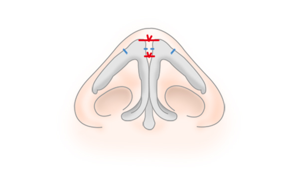 鼻尖形成・鼻尖縮小の手術方法 STEP5