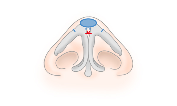 鼻尖形成・鼻尖縮小の手術方法 STEP6
