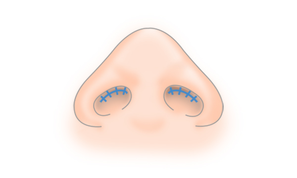 鼻尖形成・鼻尖縮小の手術方法 STEP7