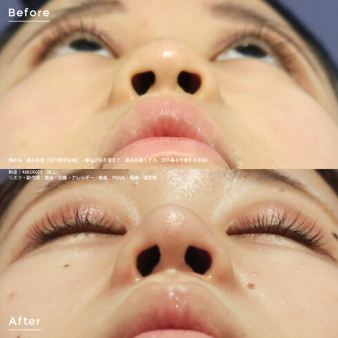 鼻の整形 その他の症例写真