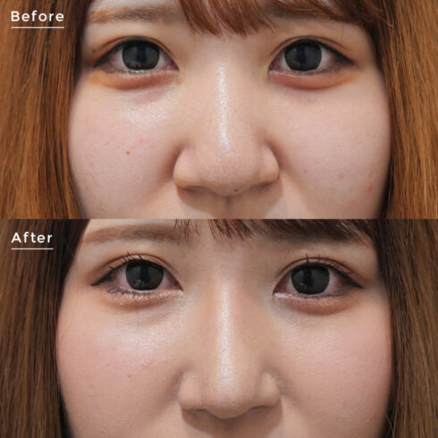 鼻の整形 その他の症例写真