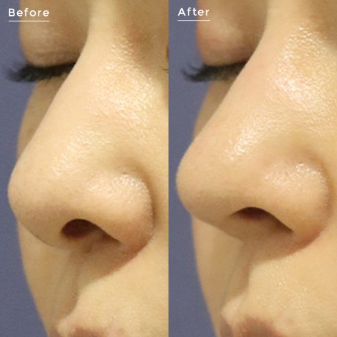 鼻の整形 その他の症例写真