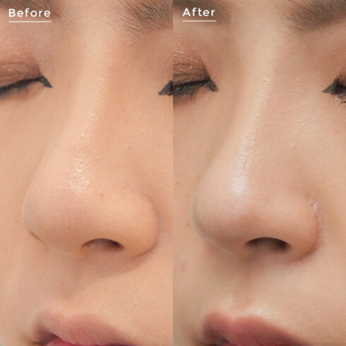 鼻の整形 その他の症例写真