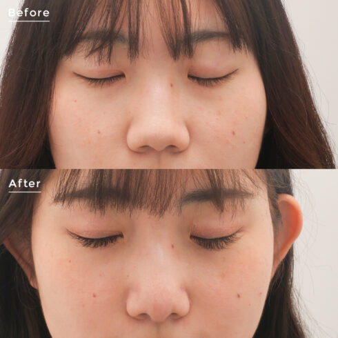 鼻の整形 症例写真